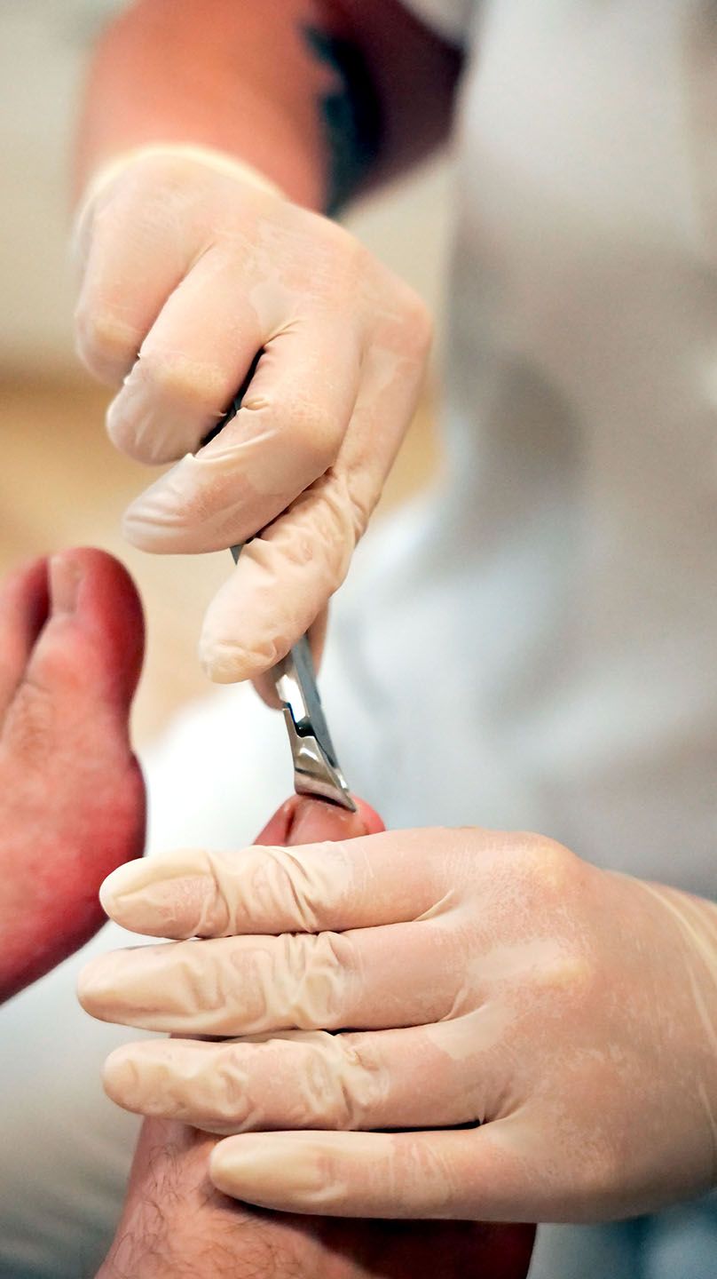 Behandlung bei Polyneuropathie, medizinische Fußpflege in Wiesbaden