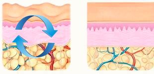 Reducción de Celulitis La imagen muestra la capa de celulitis antes y después de un tratamiento.