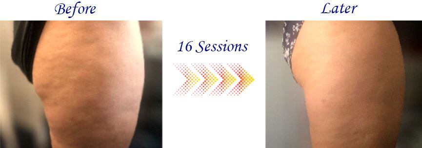 Thigh with cellulite before and after 16 sessions with the MRM Pro Wellness equipment.