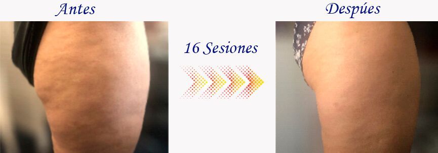 Muslo con celulitis antes y después de realizar 16 sesiones con el equipo MRM Pro Wellness.