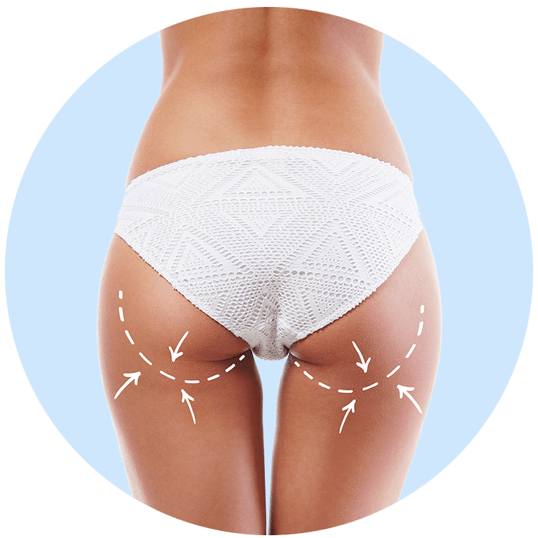 CRYO ESTHÉTIQUE CORPORELLE Femme de dos avec des flèches dans les zones traitables avec des appareils esthétiques appliquant la Cryo esthétique corporelle.