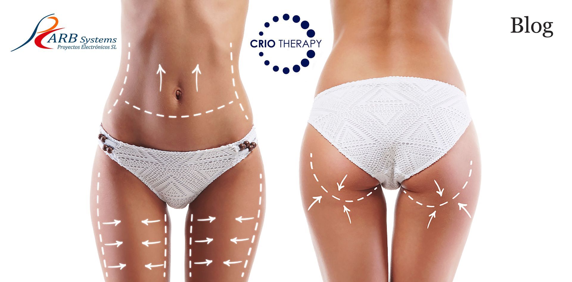 Mujer de frente y de espaldas con flechas en zonas tratables con aparatología estética aplicando Criolipolisis.