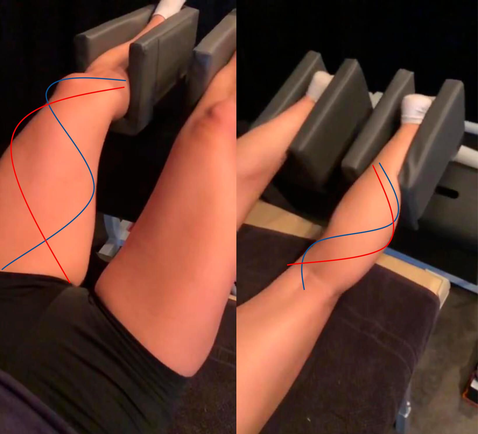 TERAPIA DE ONDA CINÉTICA Mujer en tratamiento de piernas con el equipo de aparatología estética MRM Pro Wellness. Se ven las líneas que muestran el movimiento de los músculos, la onda cinética .