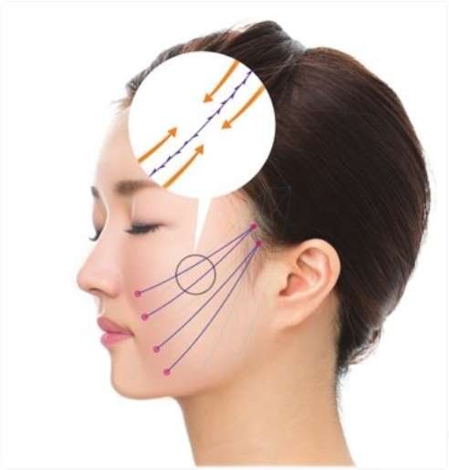 PDO thread lift sutures