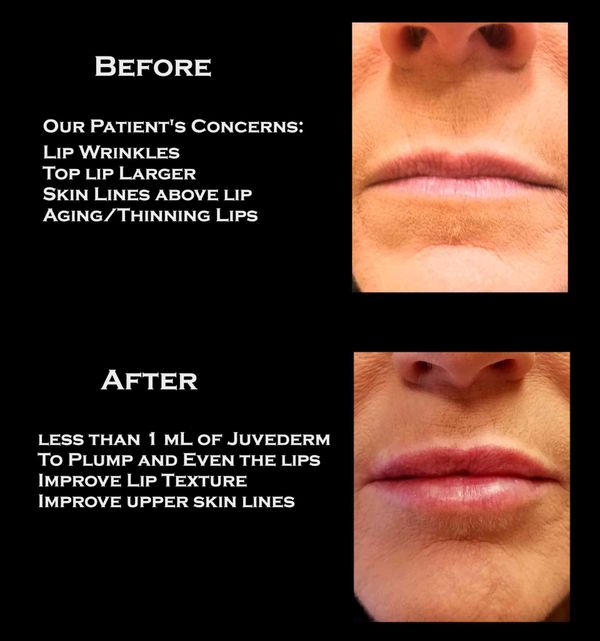Lip fillers juvederm before and after results