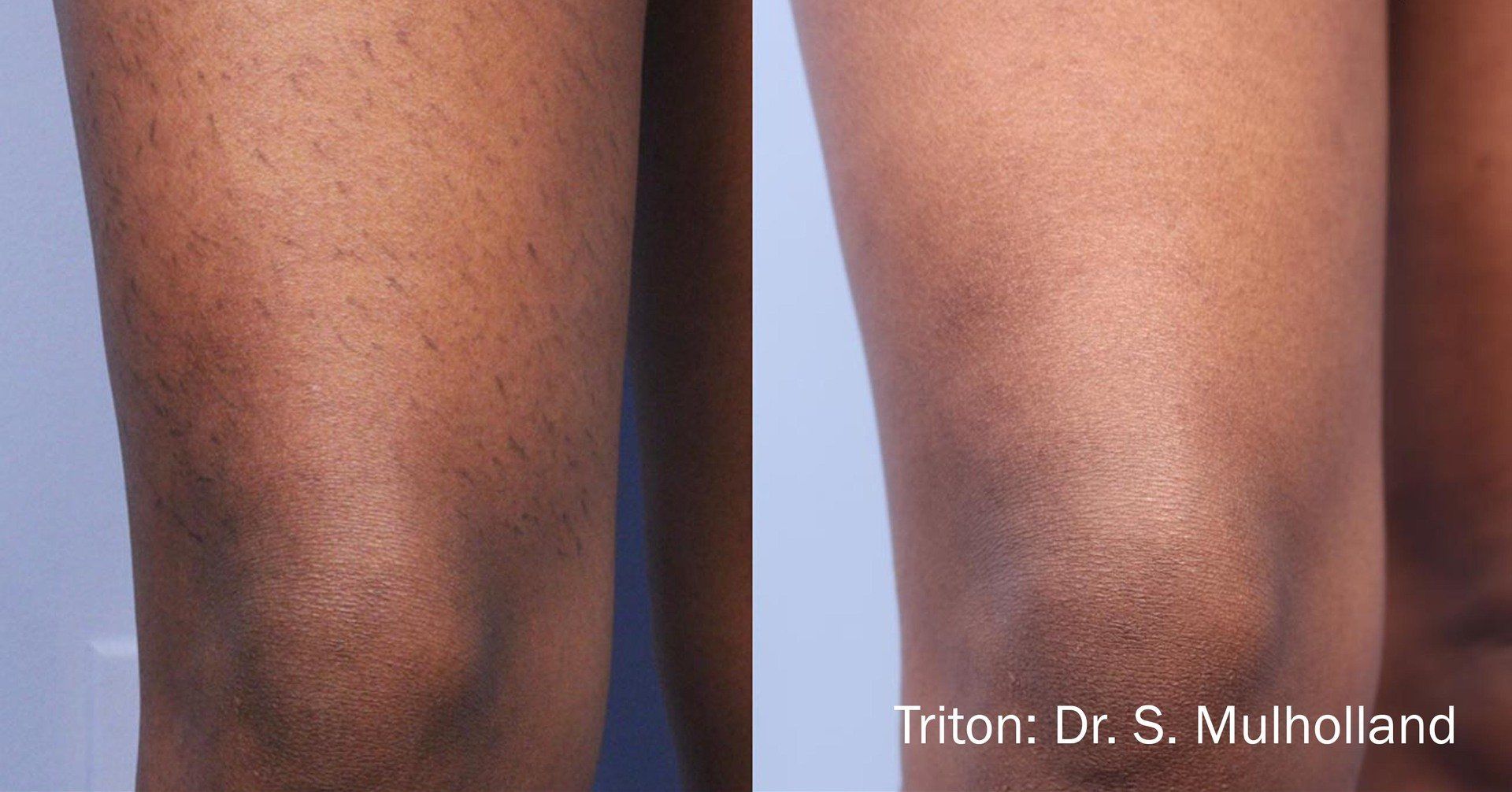 Laser Hair Removal Dark Skin Black