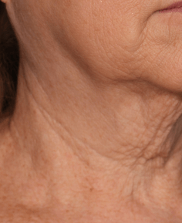 Before RF Microneedling