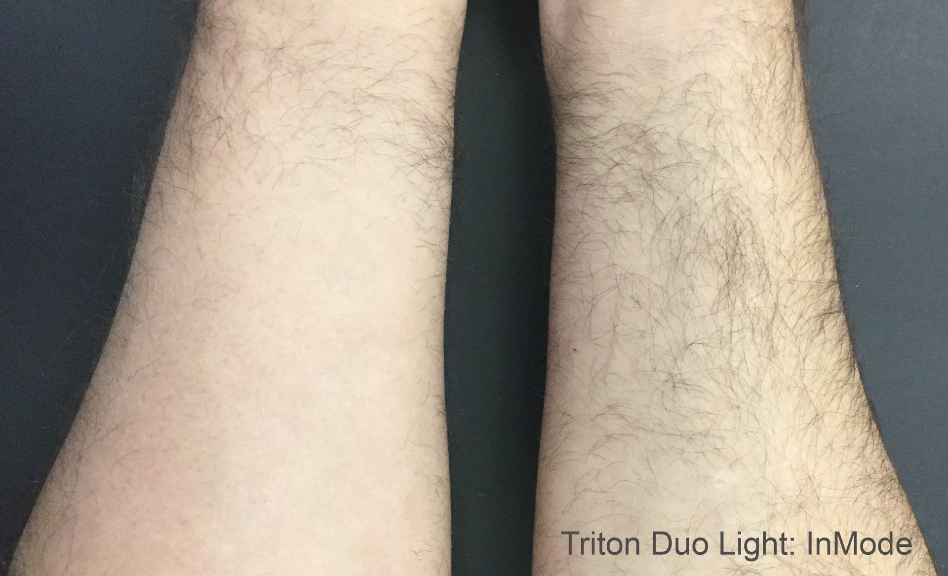 Light Skin Laser Hair Removal Results