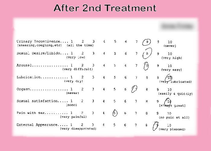 After vaginal rejuvenation experience