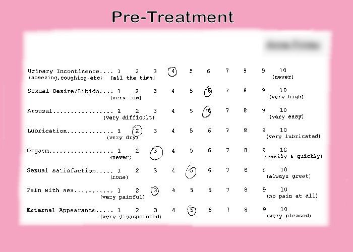 Before vaginal rejuvenation review