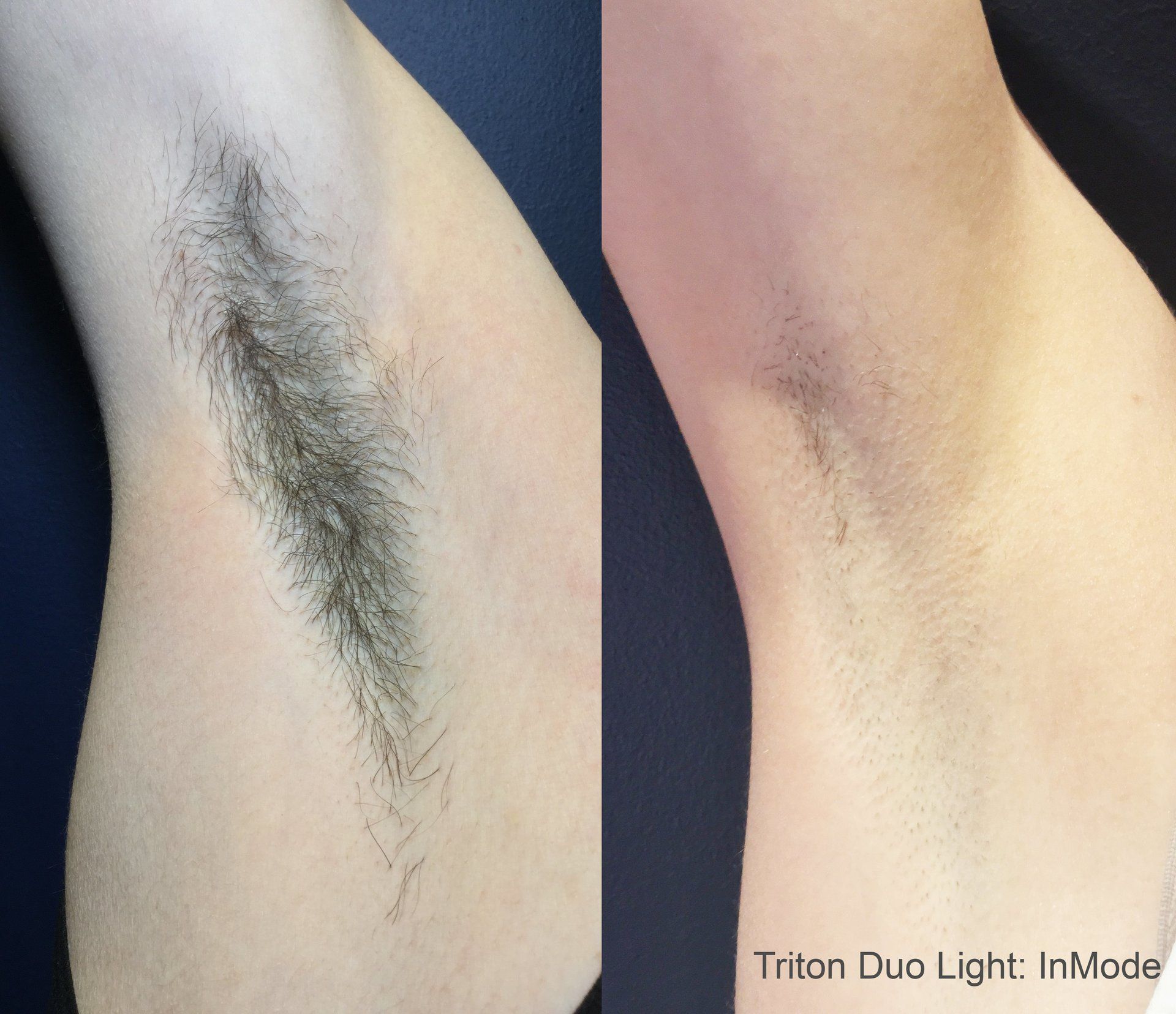 Underarms Laser Hair Removal Results