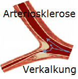Arteriosklerose Arteriosklerose Verkalkung der Blutgefäße