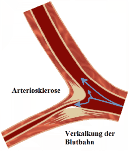 Verkalkung durch Arteriosklerose