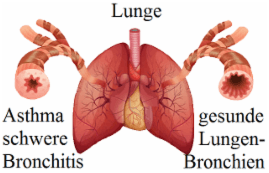 Bronchitis und Asthma alternativ heilen
