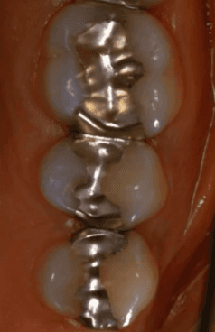 Amalgam Plomben Gifte