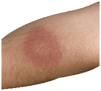 Wanderröte durch Borreliose