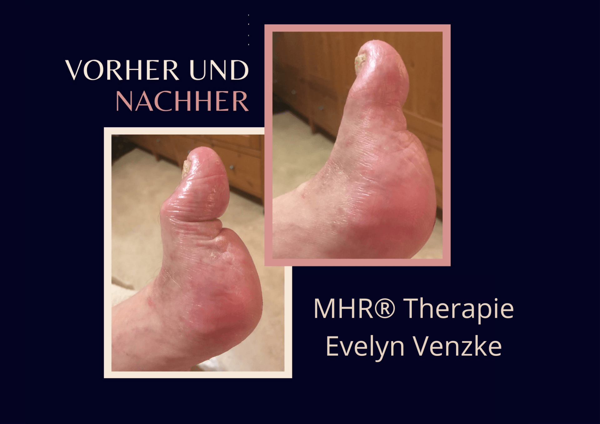 Grosszeh vor und nach der ersten Behandlung mit MHR® Myofaszialer Schmerztherapie