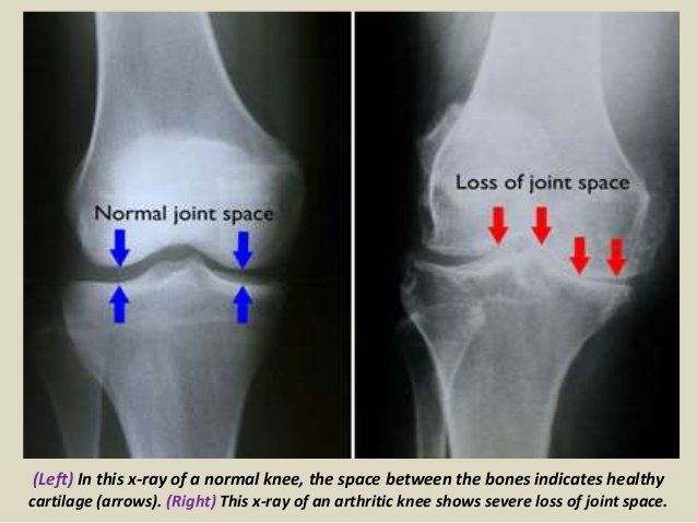 Example of Osteoarthritis on Xray Example of Osteoarthritis on Xray