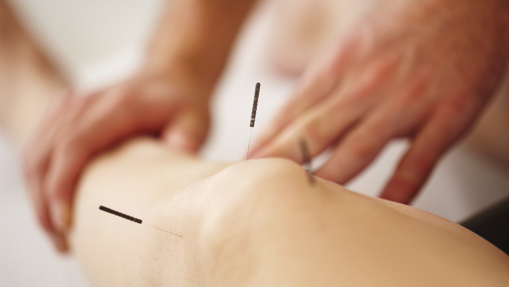 Akupunktur