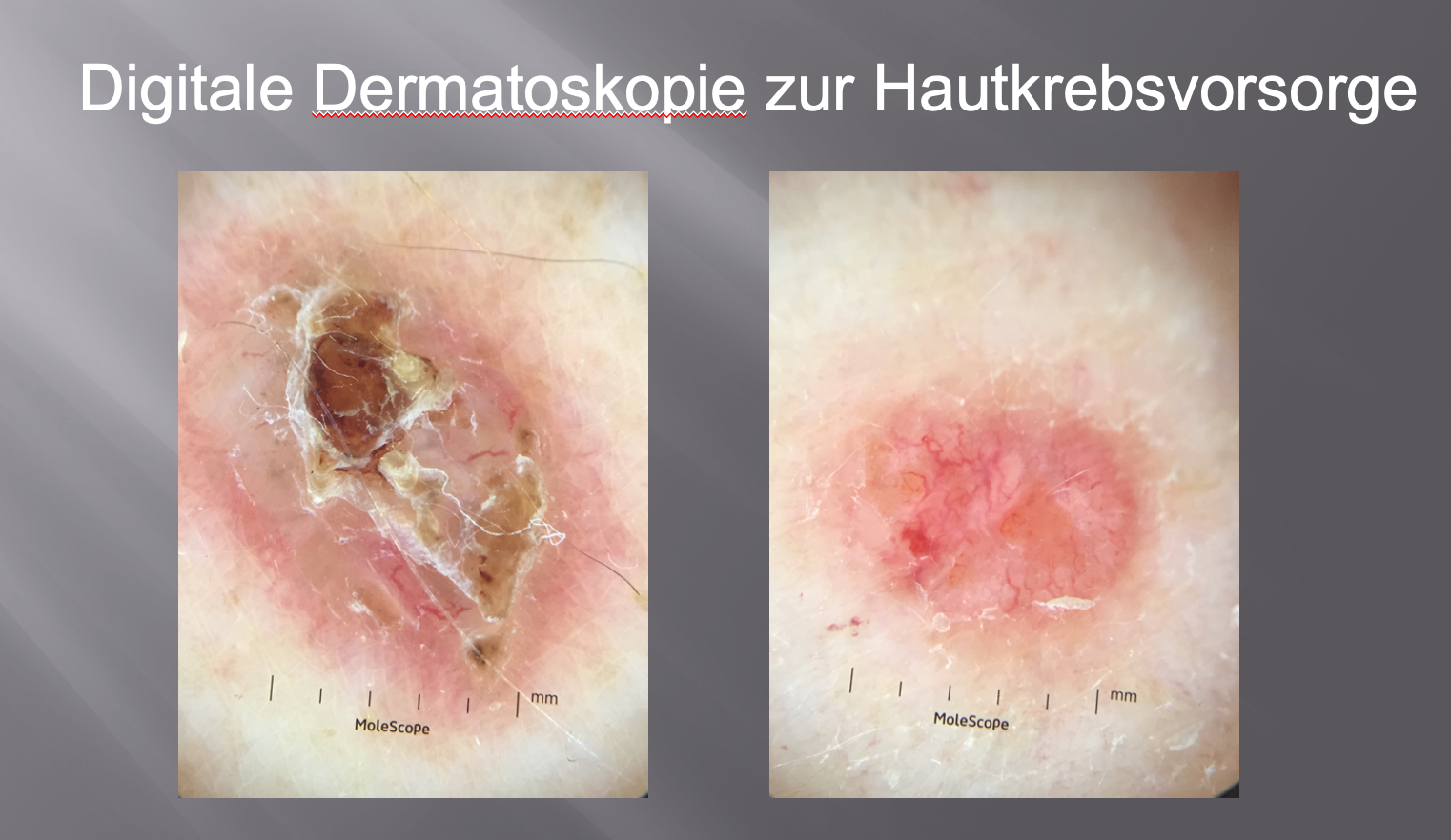 Symbolbild Abbildungen Hautkrebs