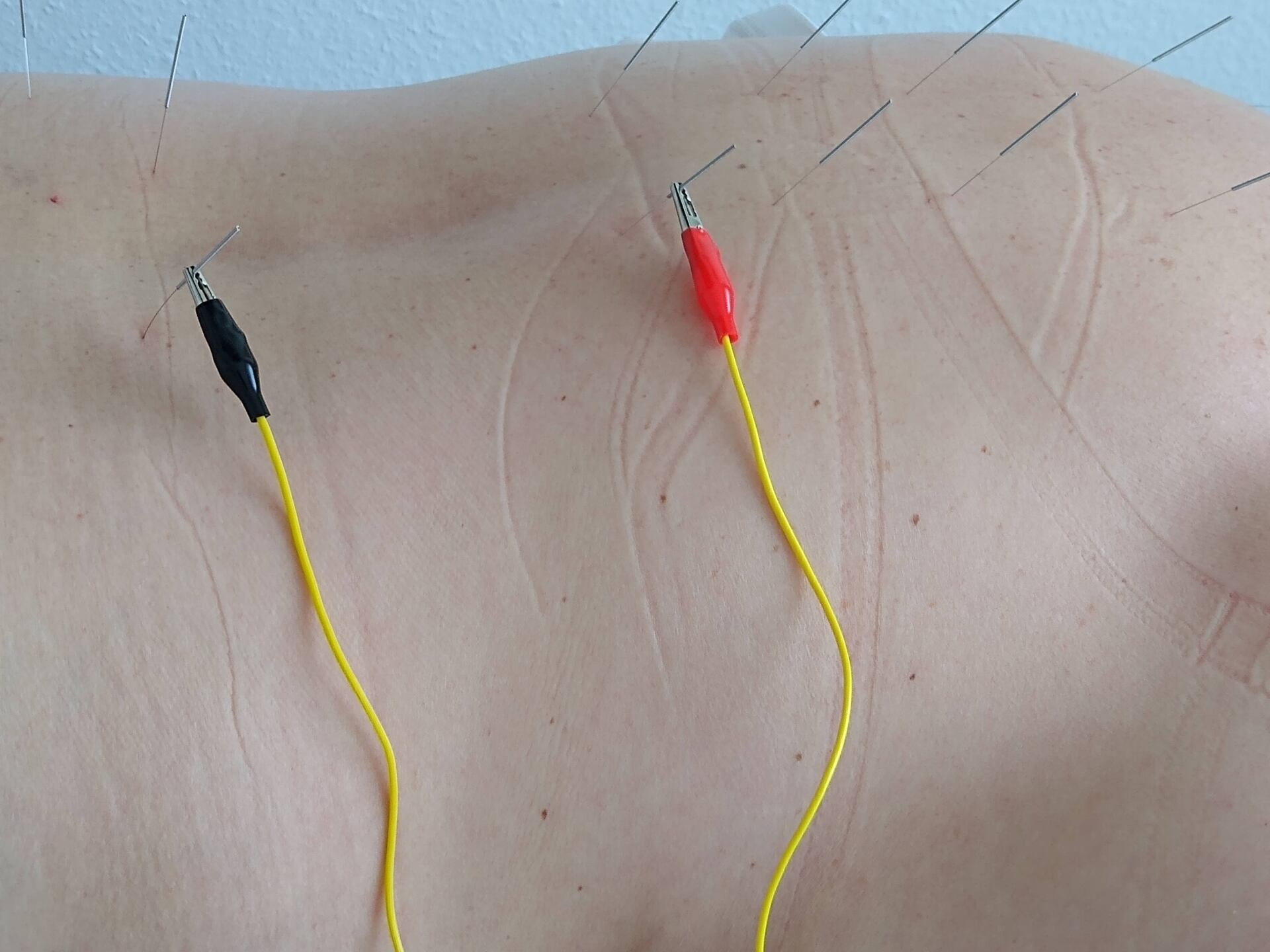 Elektroakupunktur ist die Kombination von Nadelakupunktur und speziellen Stromimpulsen.