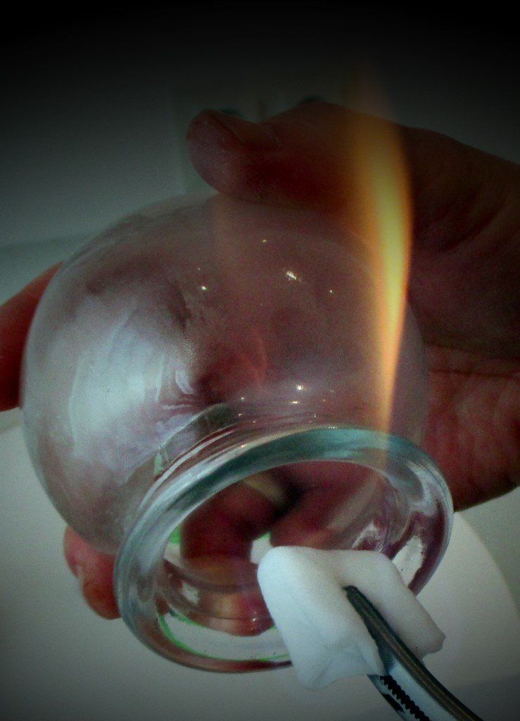 Schröpfen mit Schröpfgläsern und Feuer