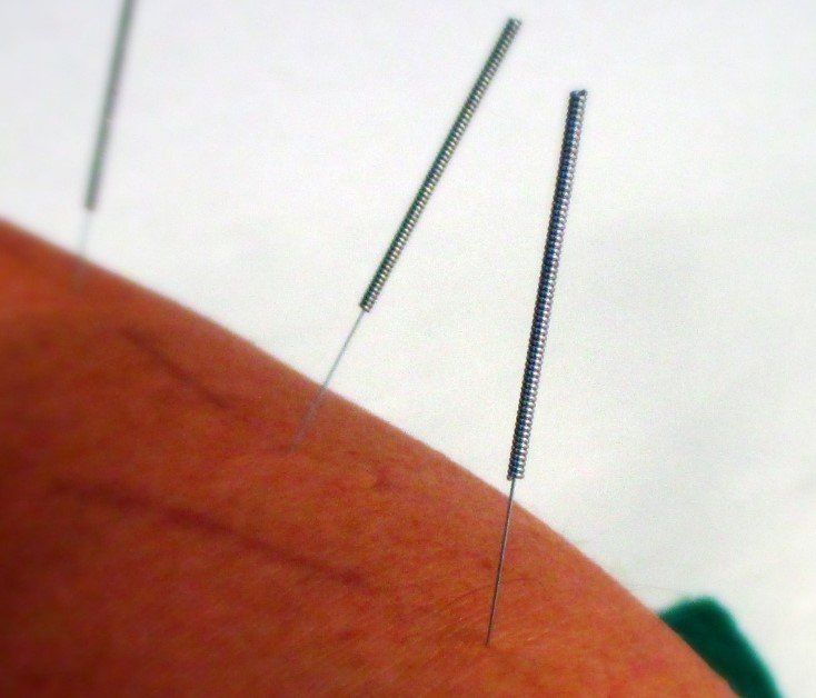 Chinesische Akupunktur, Akupunkturnadeln, Meridianpunkte
