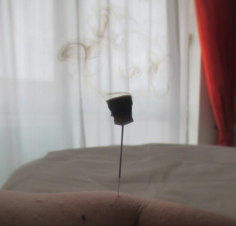 Wärme des glimmenden Moxa-Krauts wird über eine Nadel in den Körper geleitet.