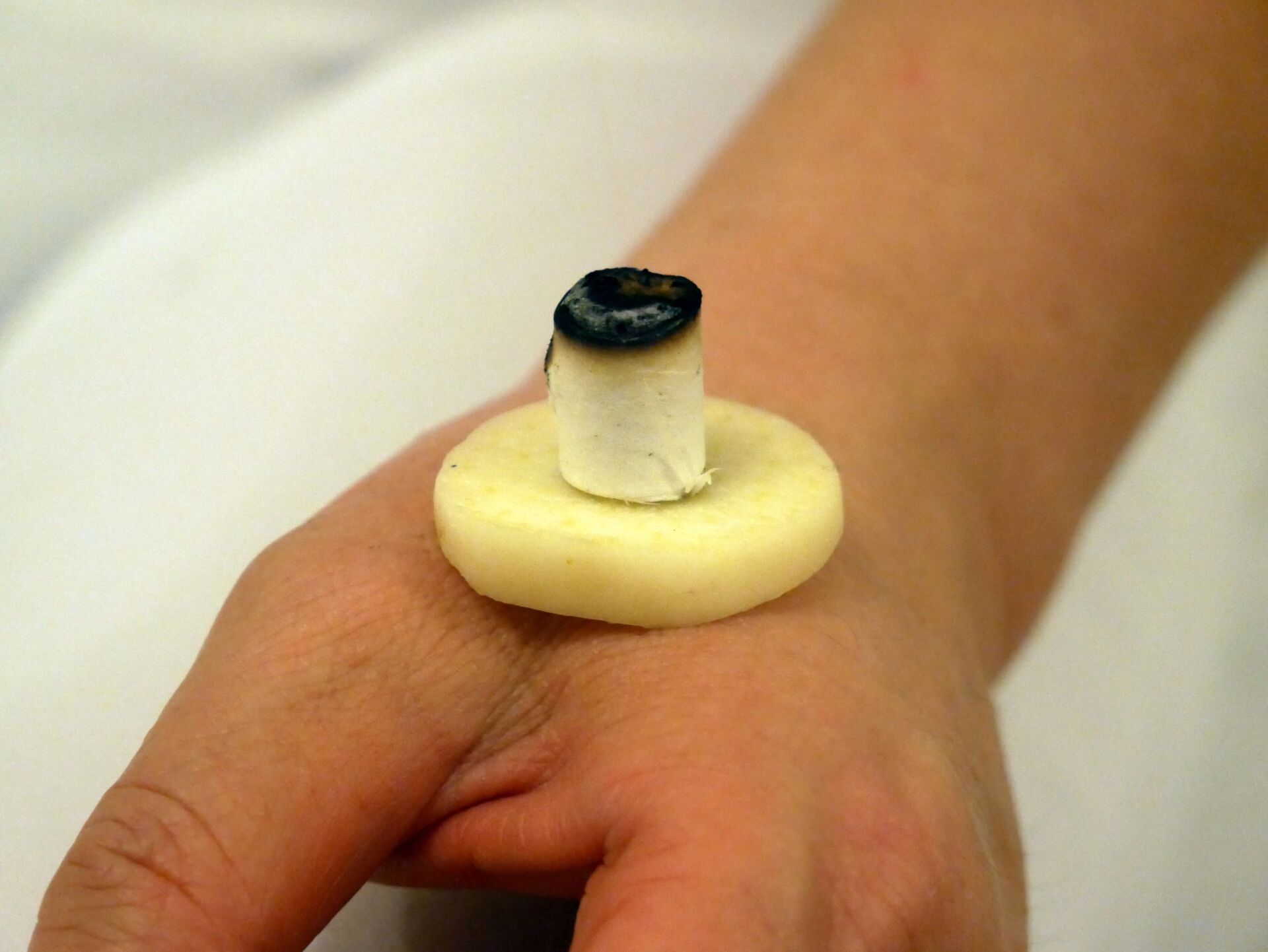 Moxibustion mit Moxa-Zigarren, Beifußkraut, in Kombination mit einer Scheibe frischen chinesischer Knoblauch