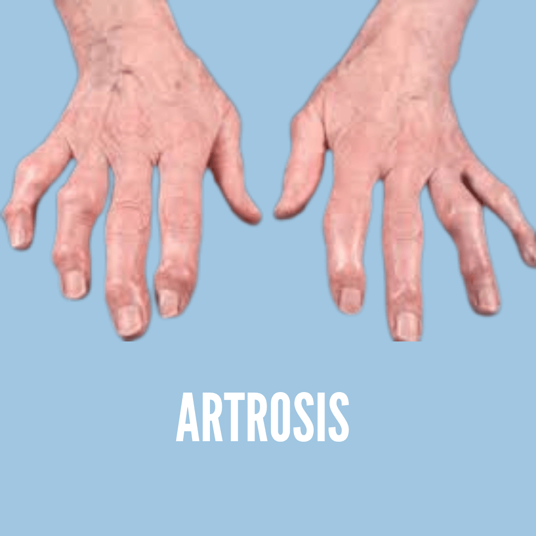 artrosis en manos, artrosis