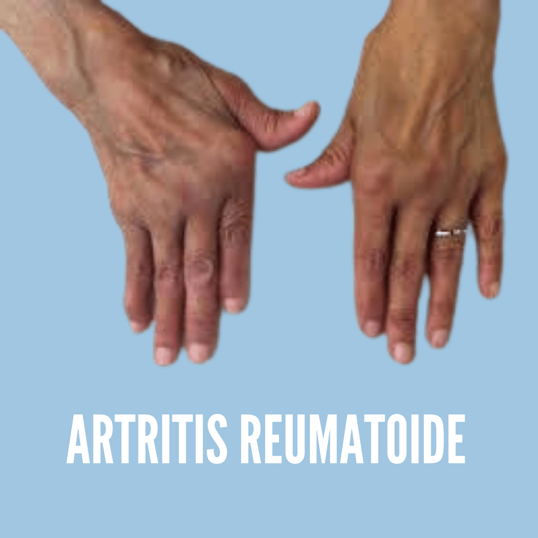 artritis en manos, artritis