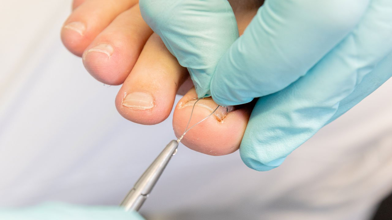 Orthonyxiespangentherapie Podoplus Langenau