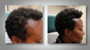 Cosmetic Alopecia