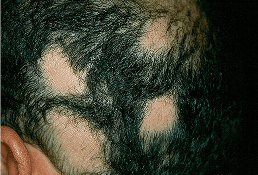 Alopecia Areata