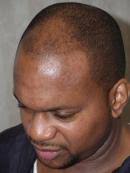 Make Pattern Baldness