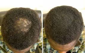 Male Thinning Crown