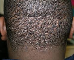 Folliculitis Nuchae
