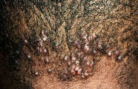 Folliculitis