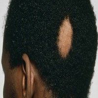Male Afro Hair loss Alopecia Areata