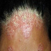 Psoriasis Scalp Condition