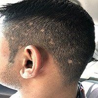 man with Acne Scarring on scalp