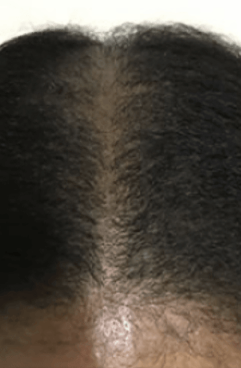 female scalp after micropigmentation