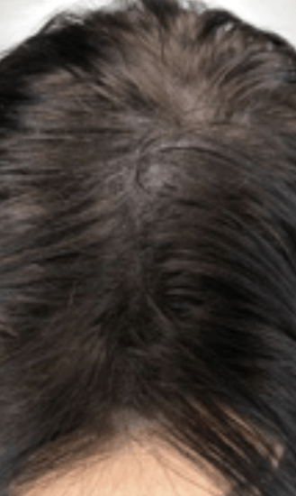 Female Scalp after Micropigmentation