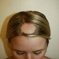 alopecia-areata-female