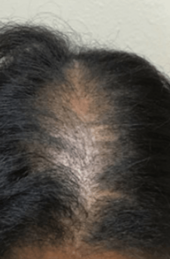 female scalp before micropigmentation