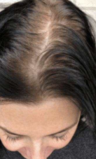 female scalp before micropigmentation