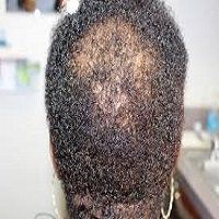 Male Afro Hair Balding