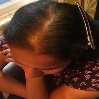 female-pattern-hair-loss