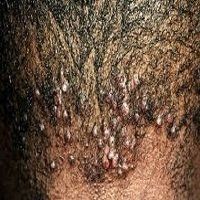 Male Afro Hair Folliculitis scalp condition