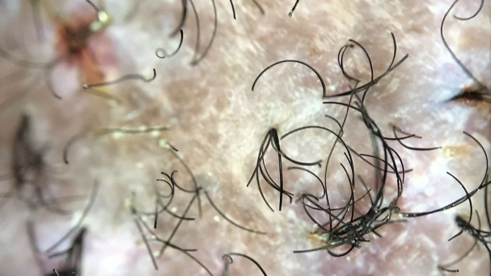 close up of flaky scalp